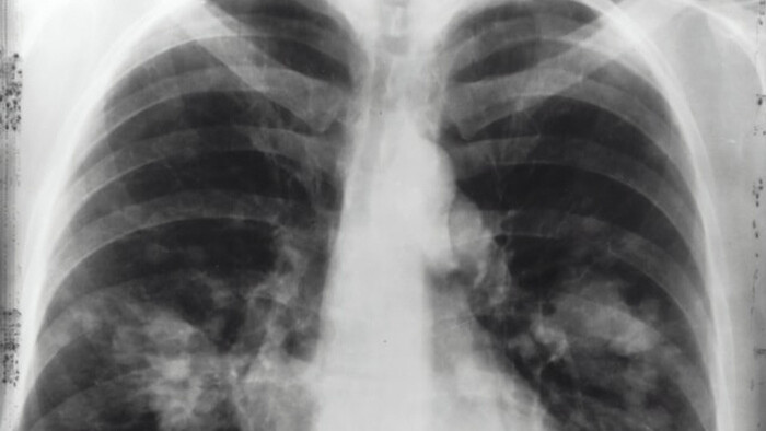 Pľúcna hypertenzia – vzácne ochorenie